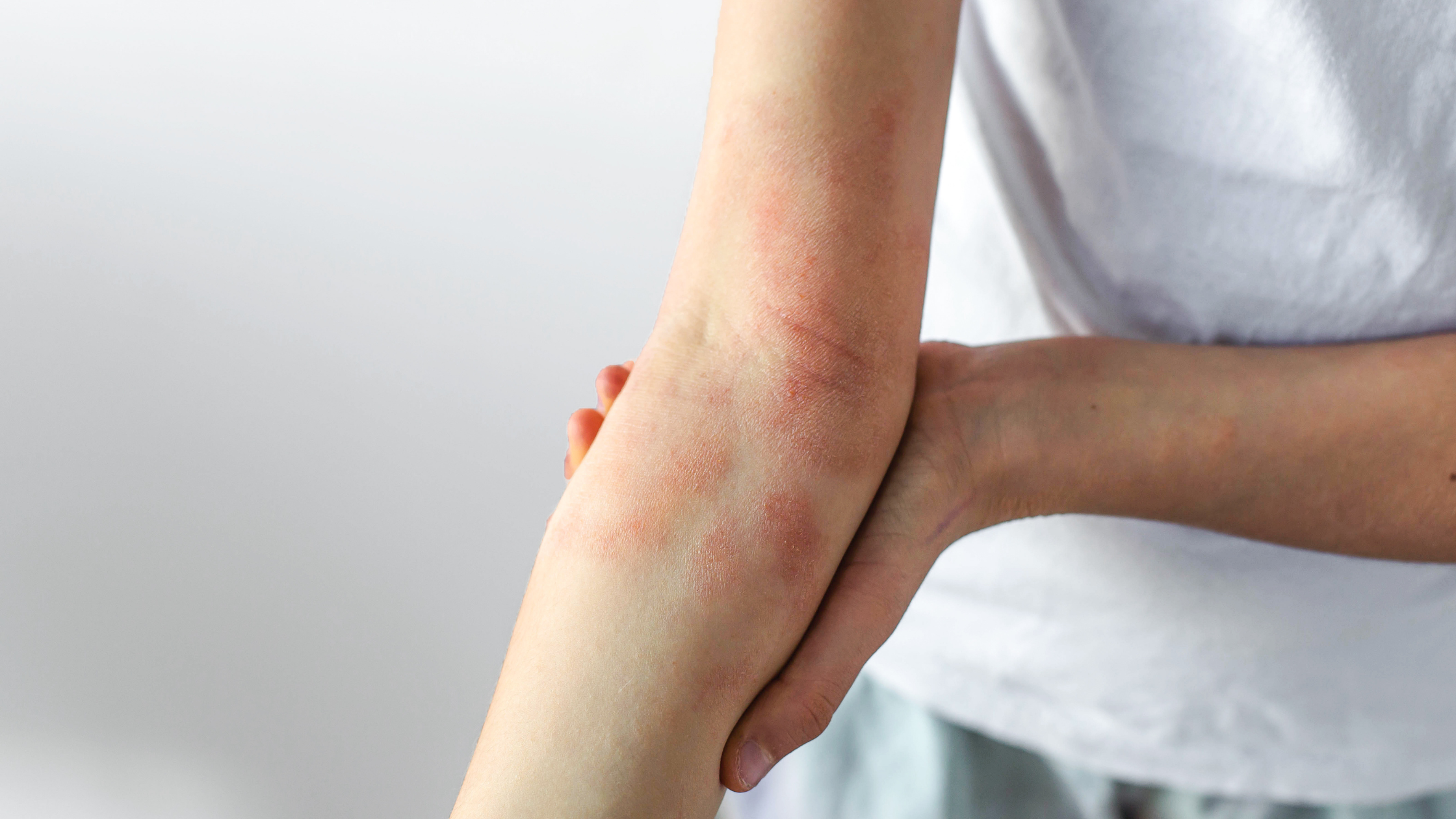 What Ingredients Should You Avoid If You Have Eczema-Prone Skin? Common Triggers to Watch For