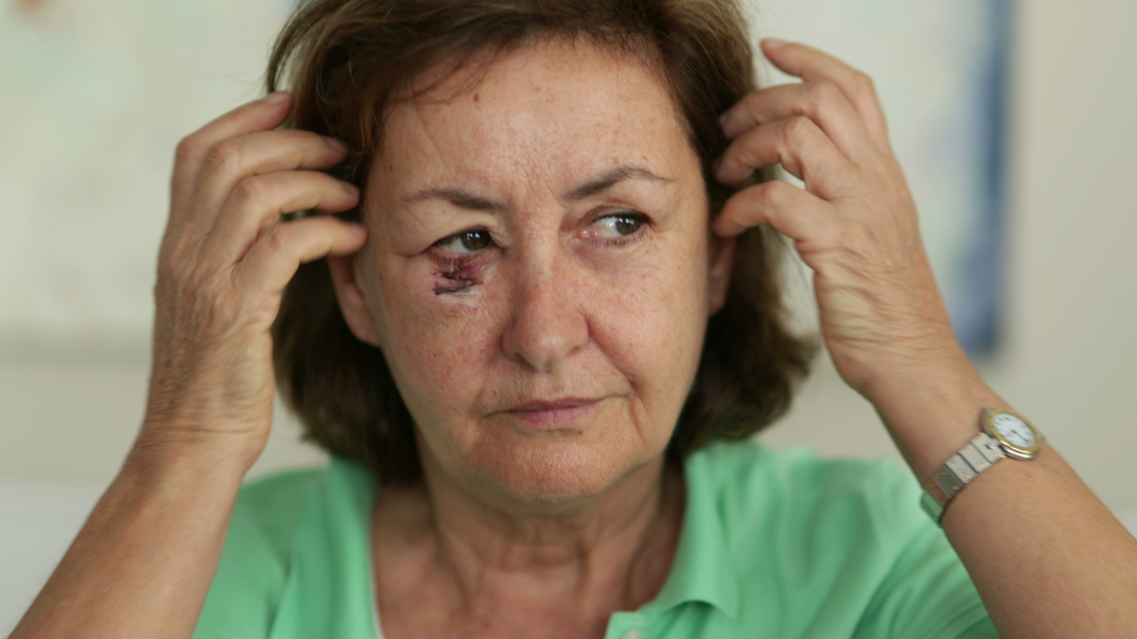 What Is the Best Scar Treatment After Mohs Surgery? Silicone Scar Care Options