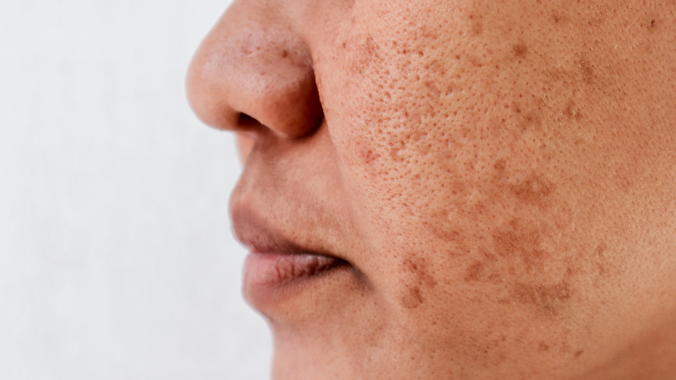 Preventing Dark Spots and Long-Term Skin Damage: What Your Daily Routine Should Include