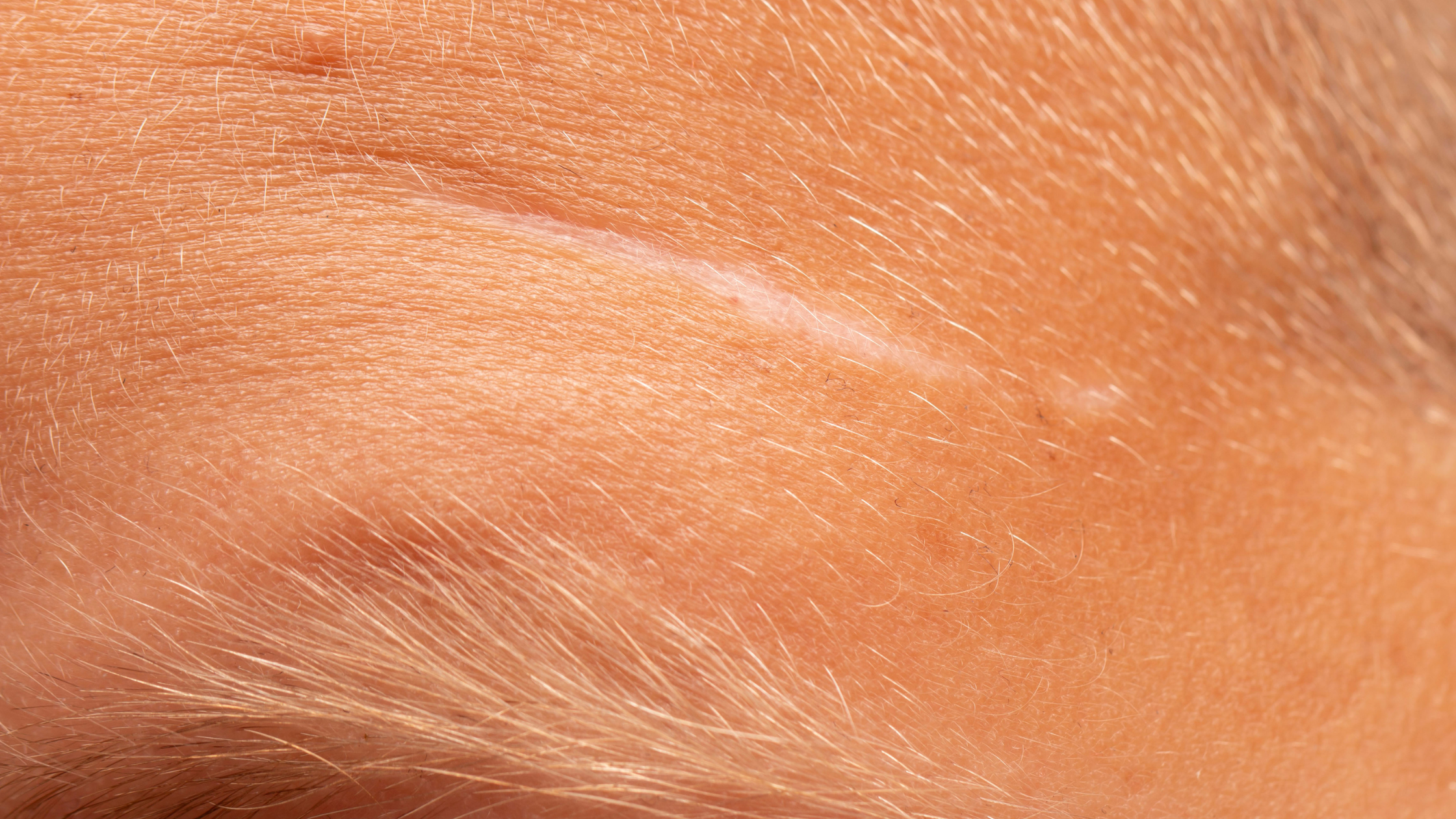 Can Scar Tissue Get Sunburned?