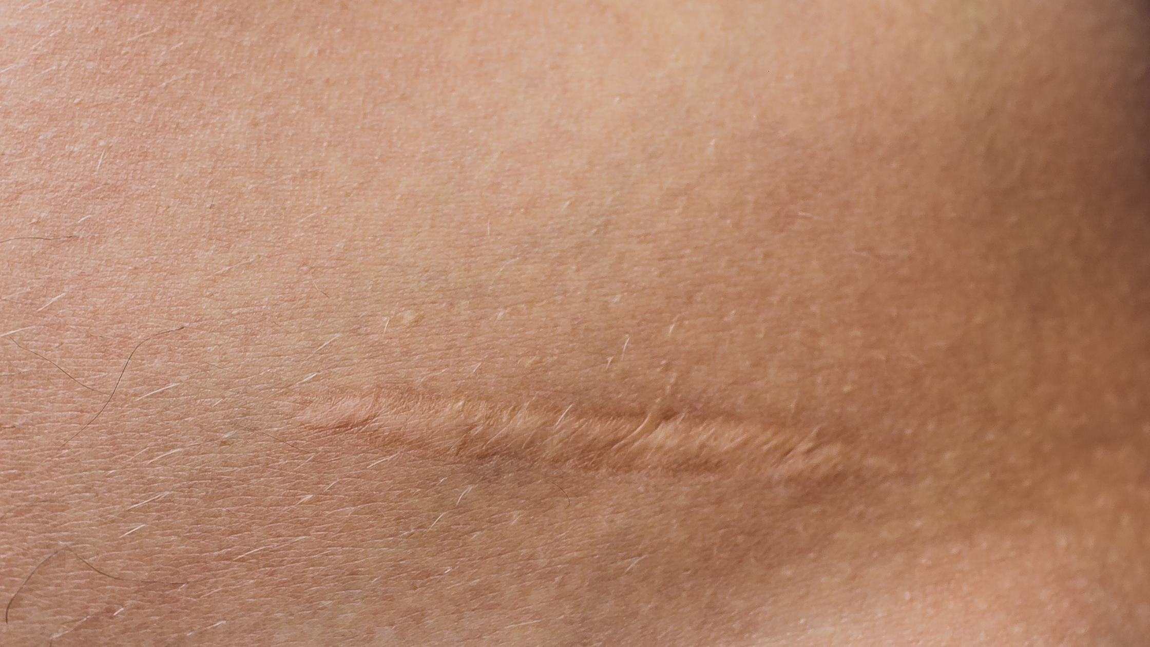 When Is a Scar Fully Healed?