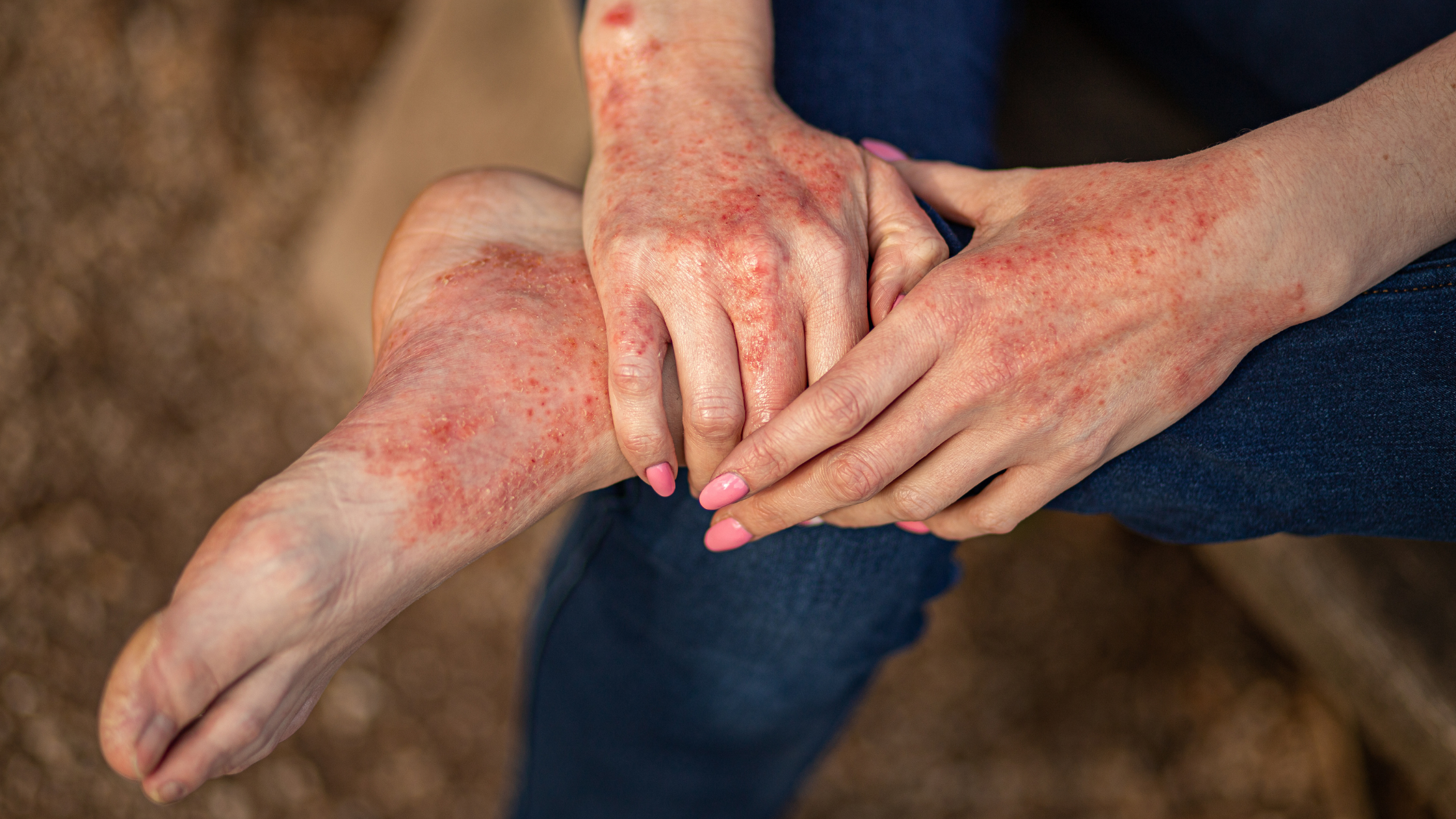 Staph & Eczema: Breaking the Cycle of Skin Infections