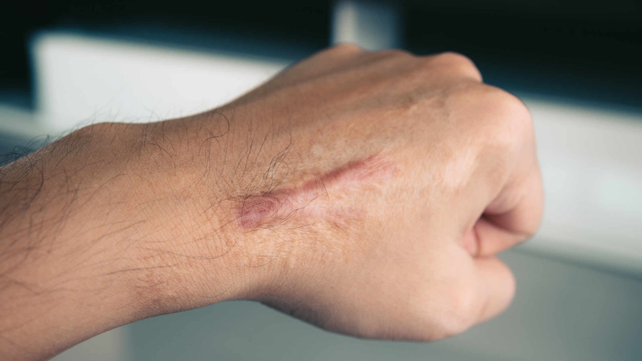 4 Frequently Asked Questions About Keloid Scars