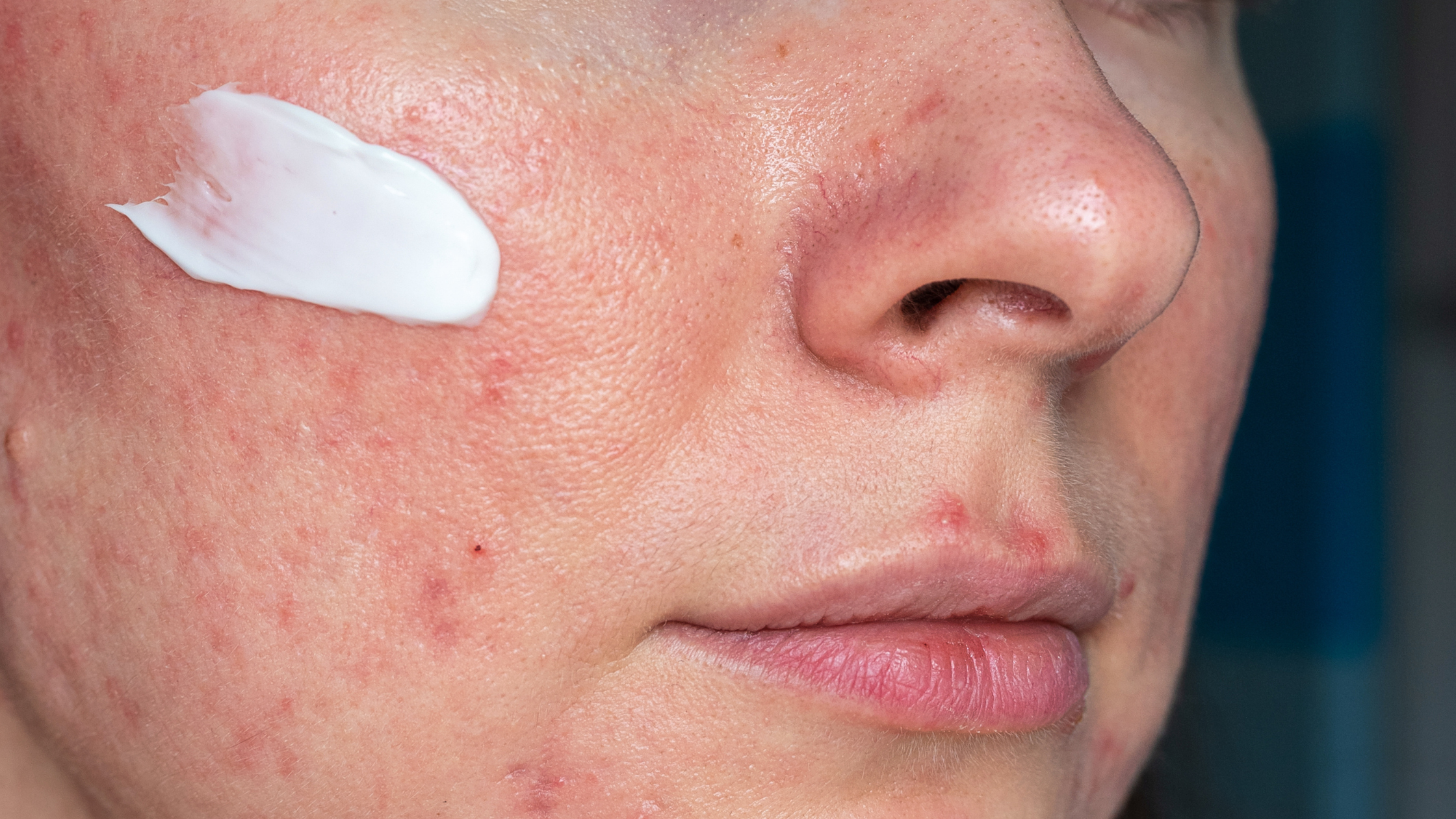 Long-Term vs. Short-Term Skin Barrier Damage: Effects, Recovery Tips, & Essential Skincare Solutions