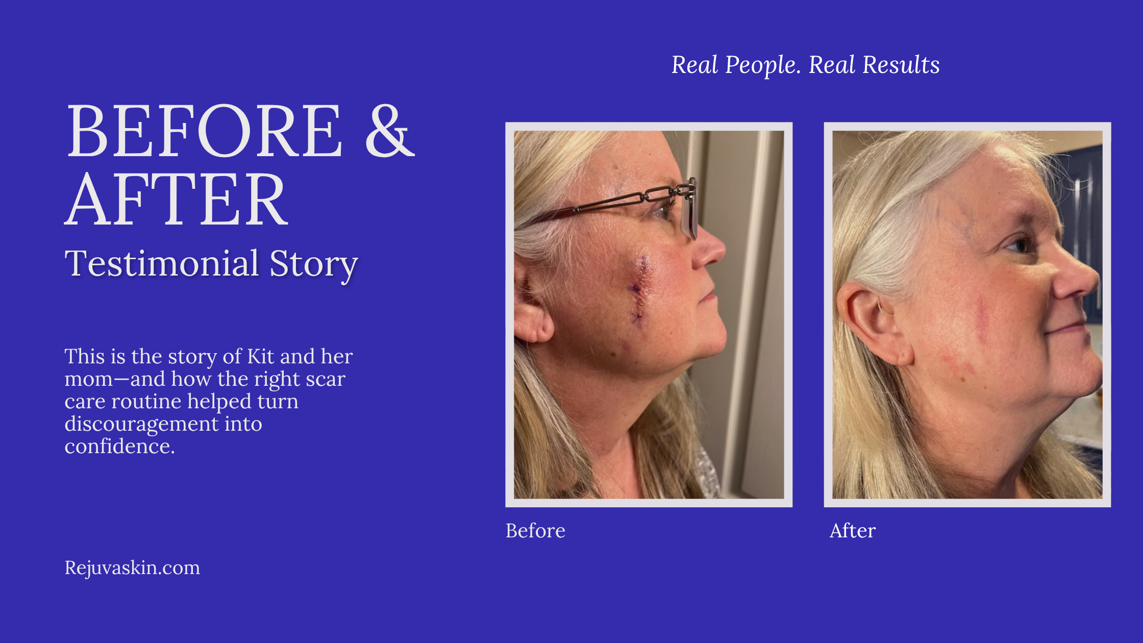 Caregiver Scar Care Story: Helping a Parent Regain Confidence After Mohs Surgery