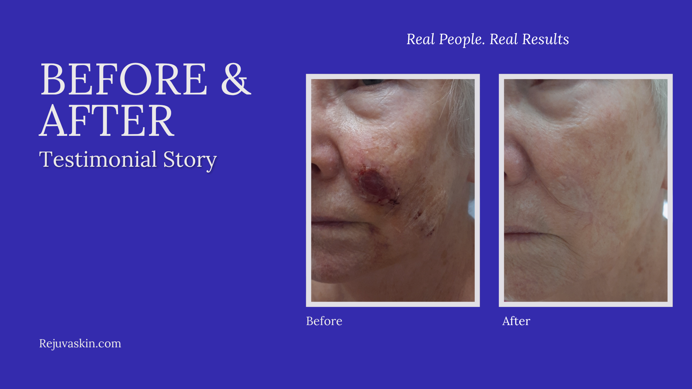 Diane’s Skin Cancer Scar Story: How Silicone Scar Care Supported Her Healing Journey