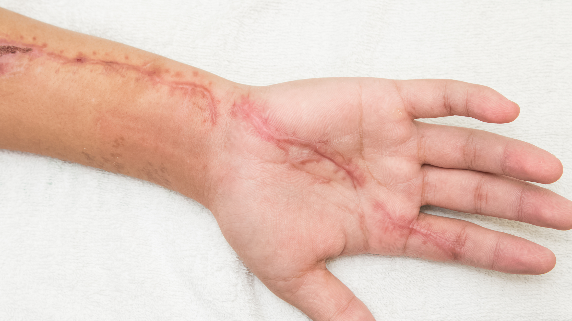 Why Does My Scar Itch? Understanding Itchy Scars and Finding Relief