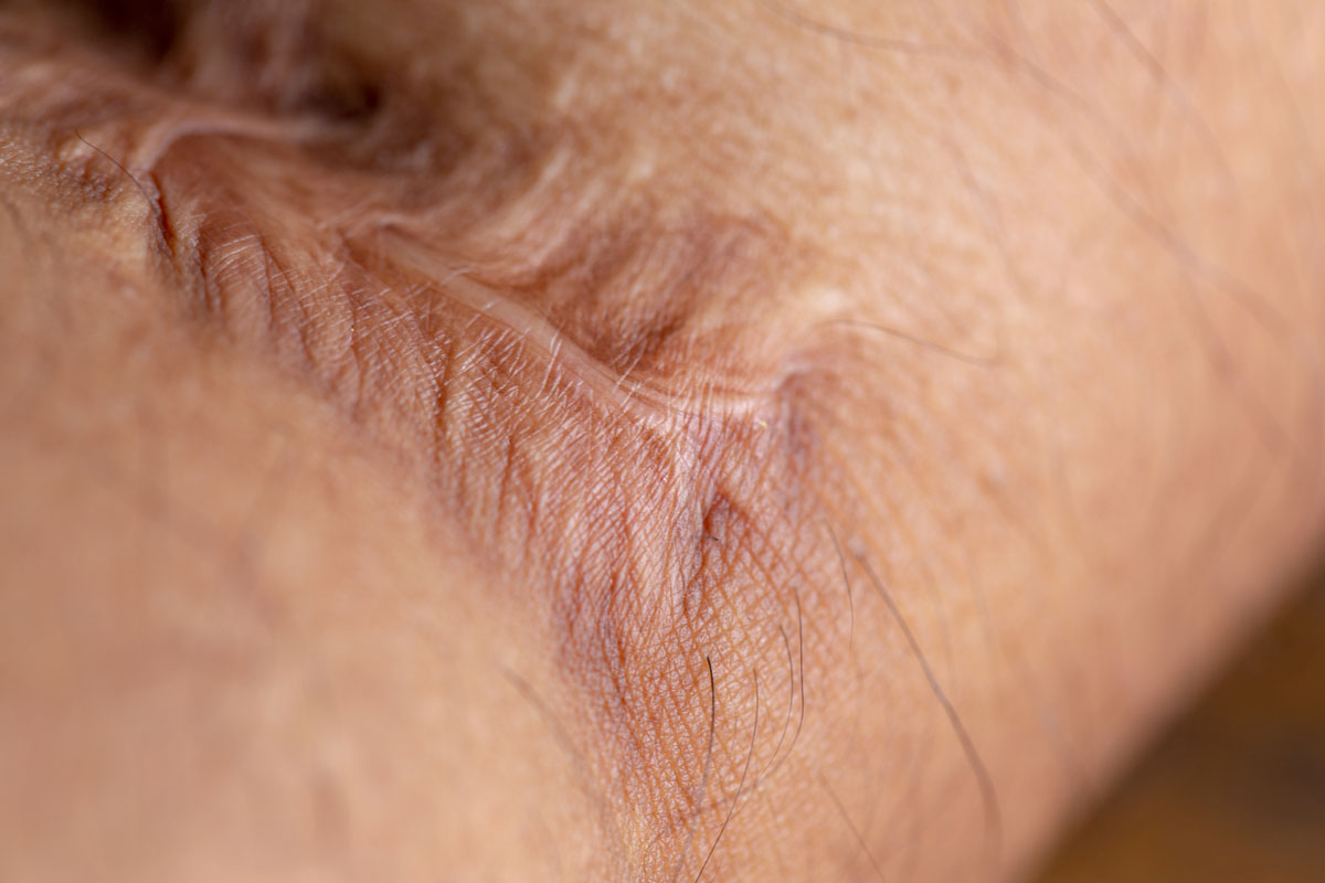 5 Key ingredients for Scar Management