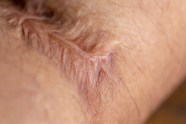 What Is A Keloid Scar?