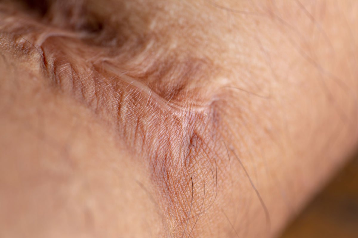 What Is A Keloid Scar?