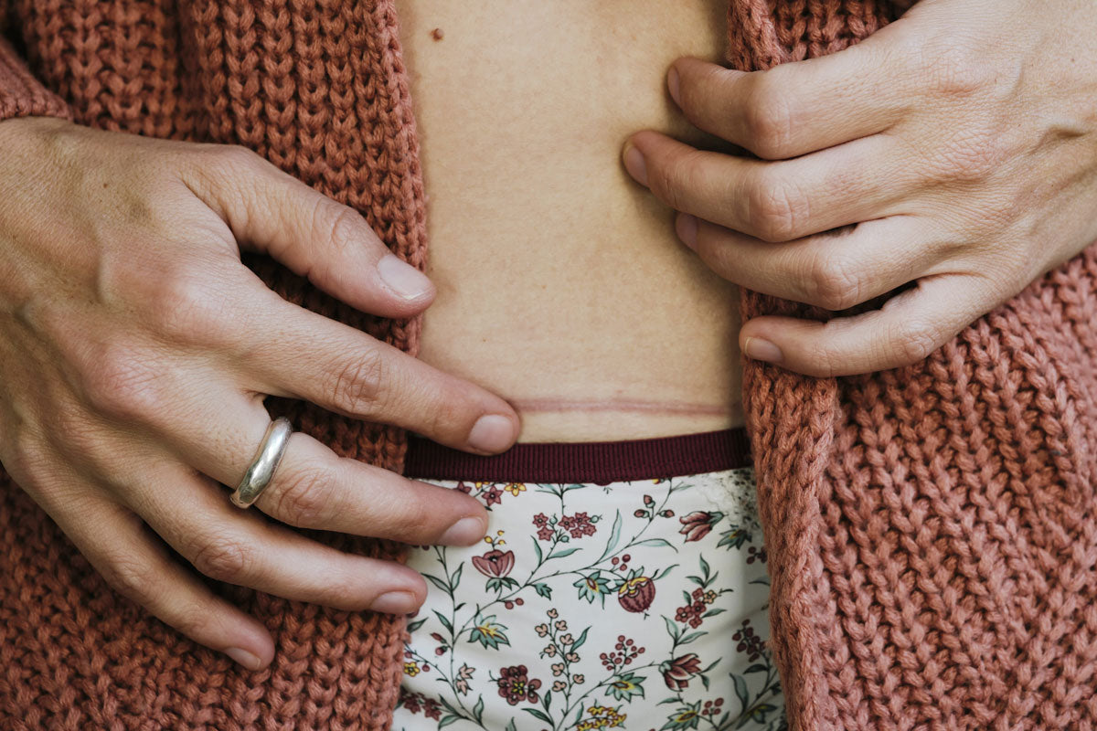 Scar Management 101: Tips For Reducing Surgery Scarring