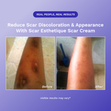 Scar Esthetique Scar Cream