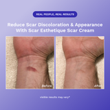 Scar Esthetique Scar Cream