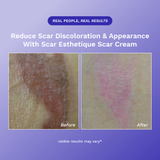 Scar Esthetique Scar Cream
