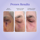 Mohs Procedure Scar Bundle