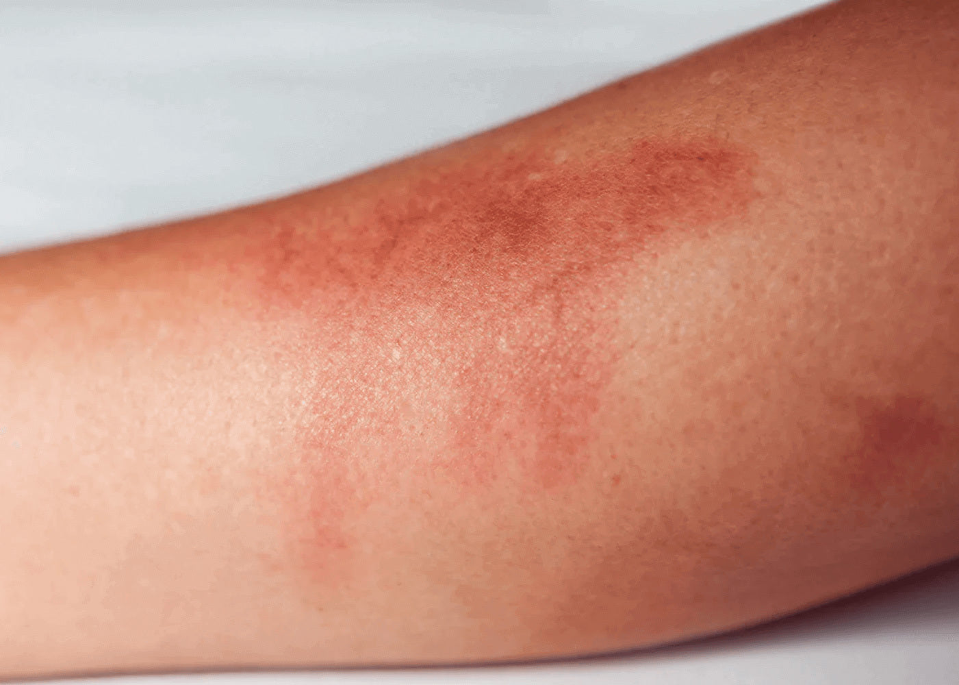 Close-up photo of red, inflamed skin on an arm during an active eczema flare-up, showing characteristic redness and irritation